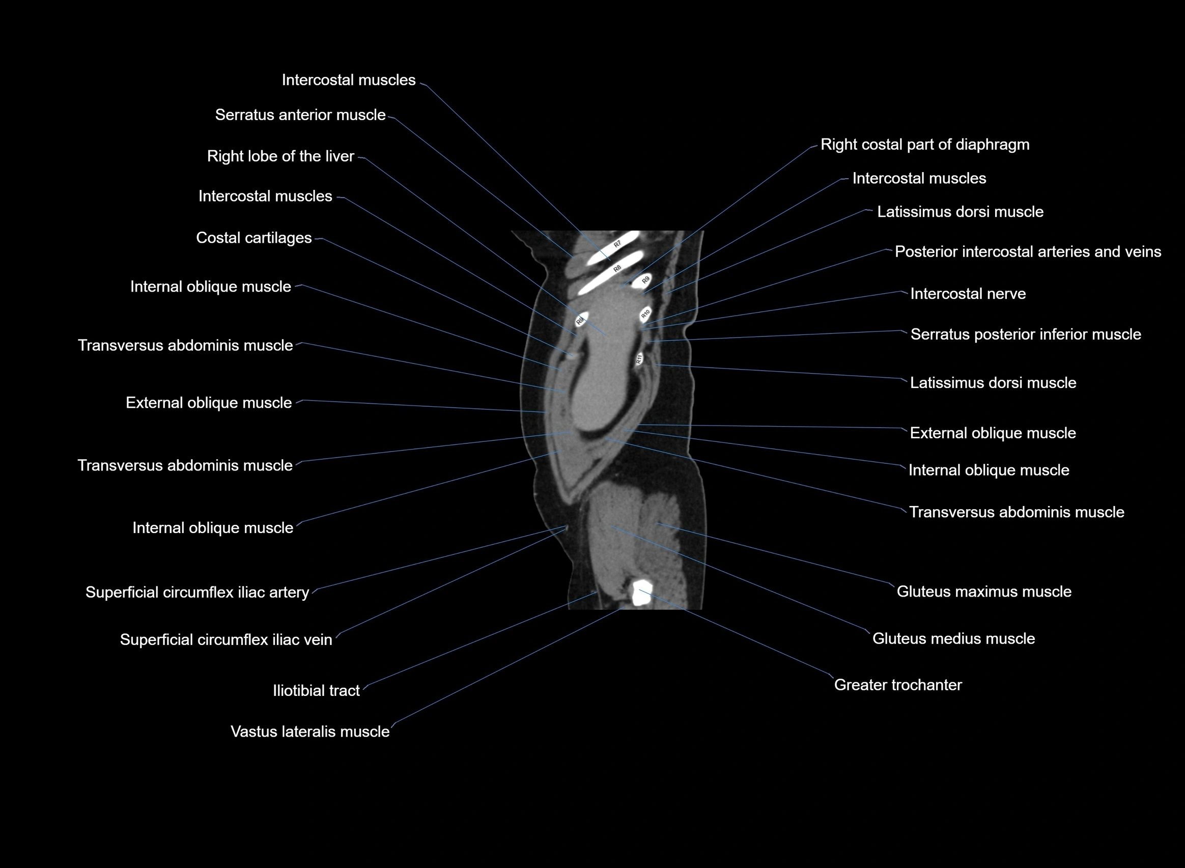 CT Abdomen sagittal cross sectional anatomy labelled radiology image -00102.webp